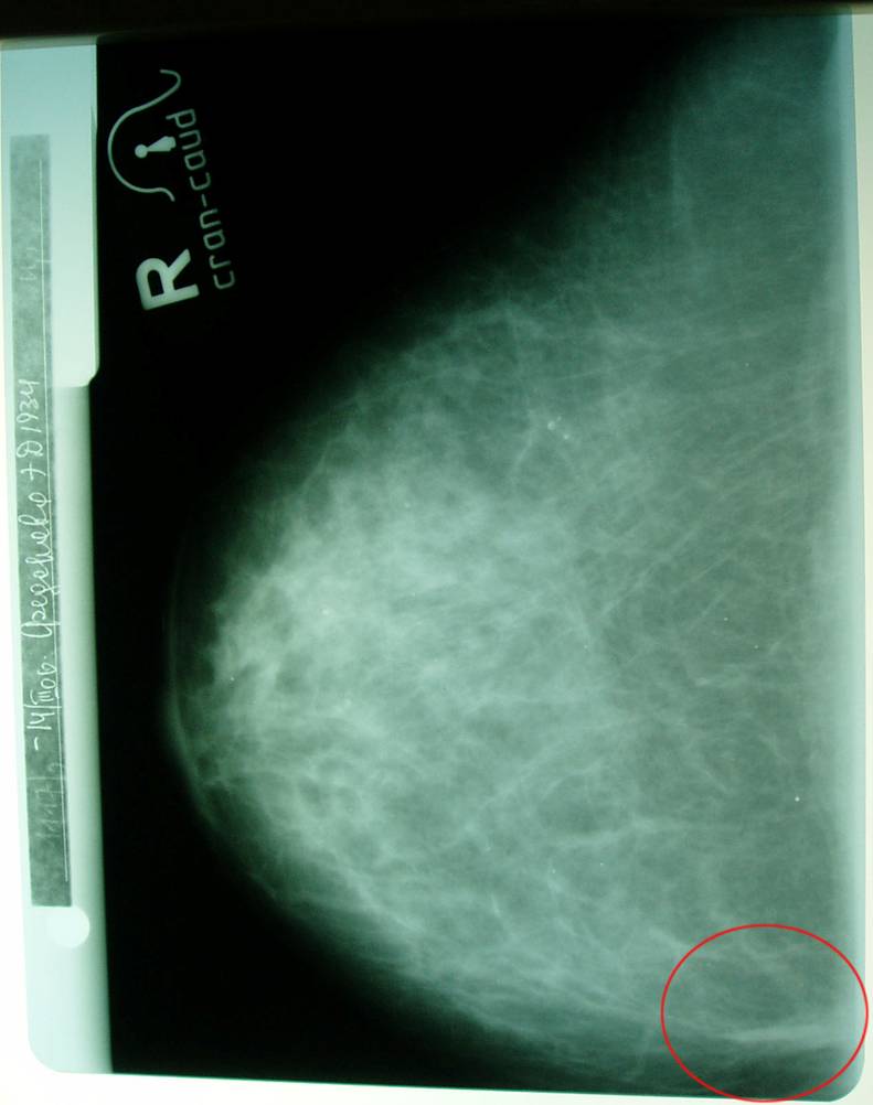 Диффузный аденоз. Маммограмма мастопатия. Фиброз молочной железы на маммограмме.