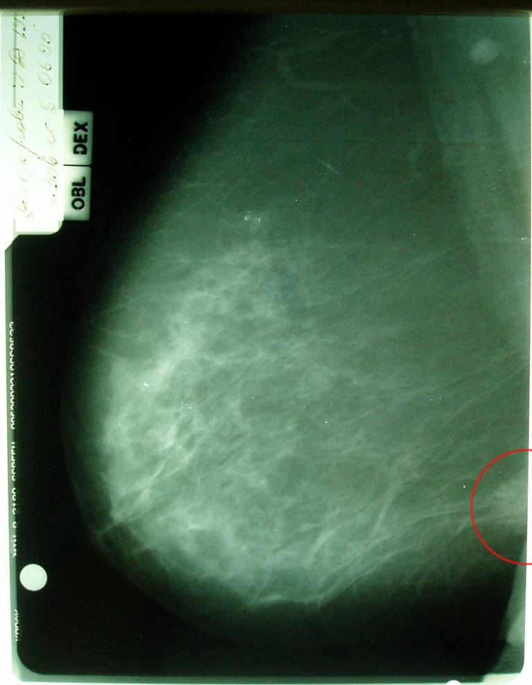 Фиброаденома молочной железы маммография. Диффузно фиброзные изменения молочных желез